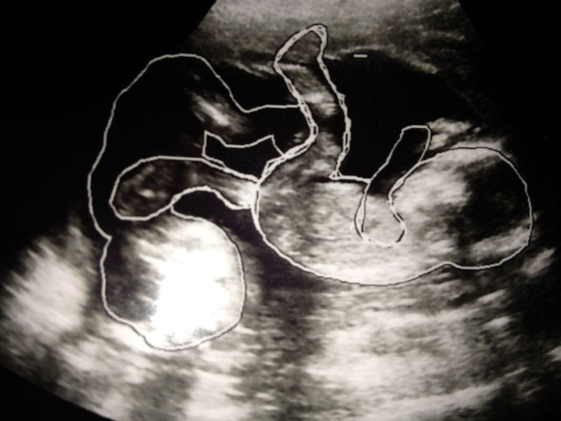 ultrasound of twins